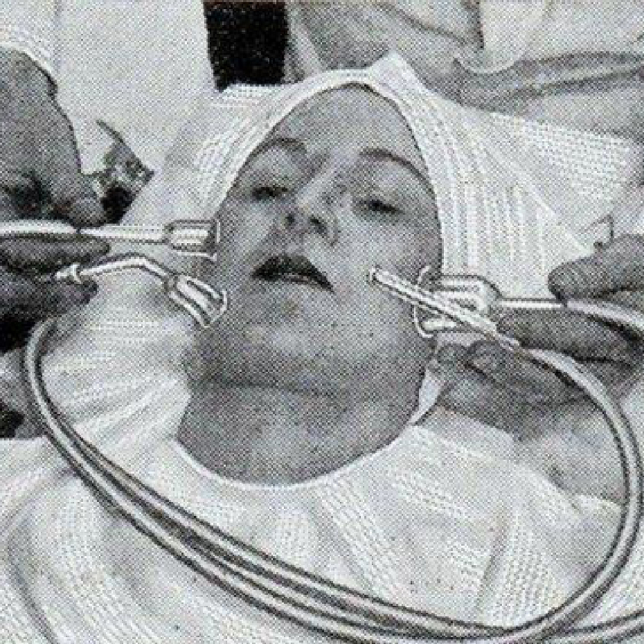 Вакуумный массаж лица, 1930 год
