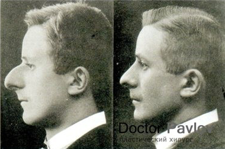 Счастливец, попавший в руки профессора Жака Йозефа в 1912 году