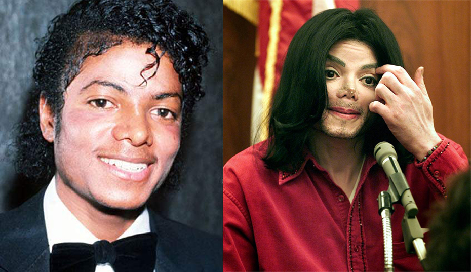 Множественные пластические операции певца и музыканта Майкла Джексона начались с «перестройки» носа в 1979 году